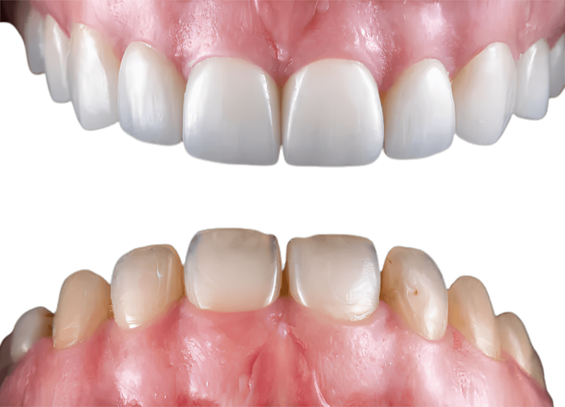 Before and after smile comparison