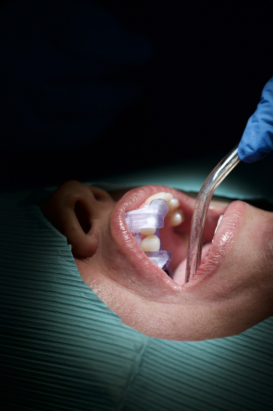 Guided implant surgery with a 3D-printed surgical guide — Nico Beliko