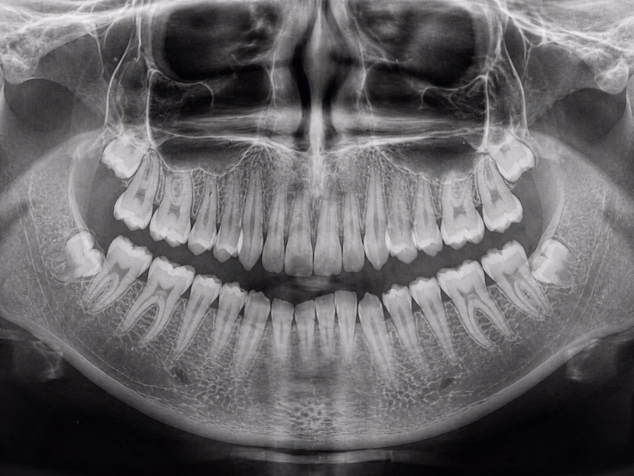 Panoramic dental radiograph