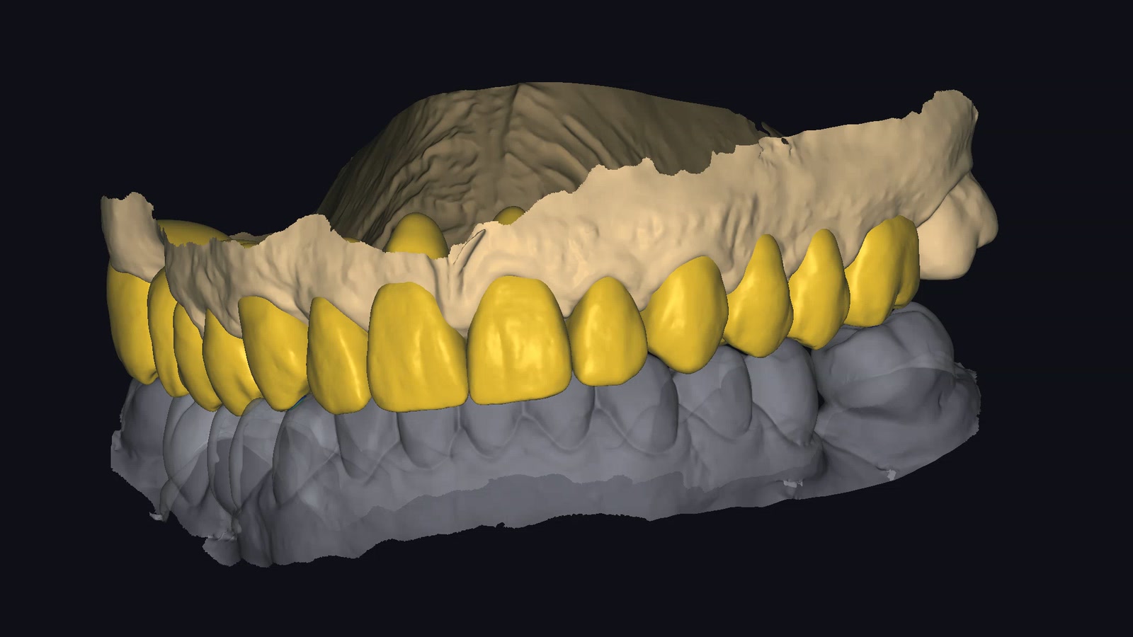 Digital full-arch implant restoration design