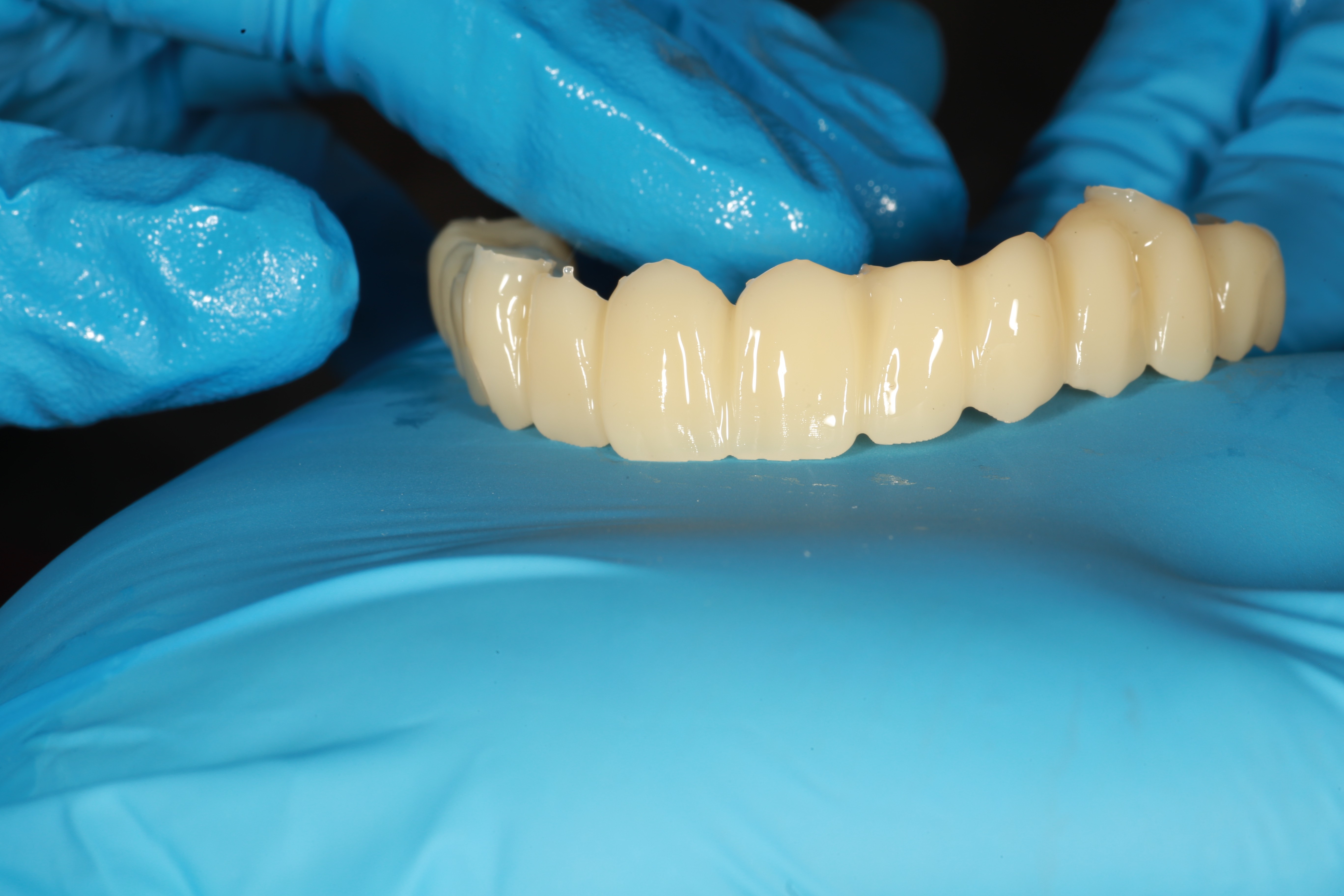 Full-arch All-on-X implant design