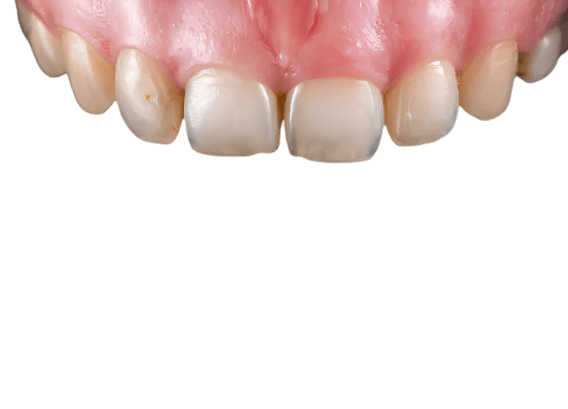 Before: original teeth