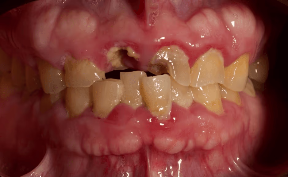 Before: worn and fractured anterior teeth