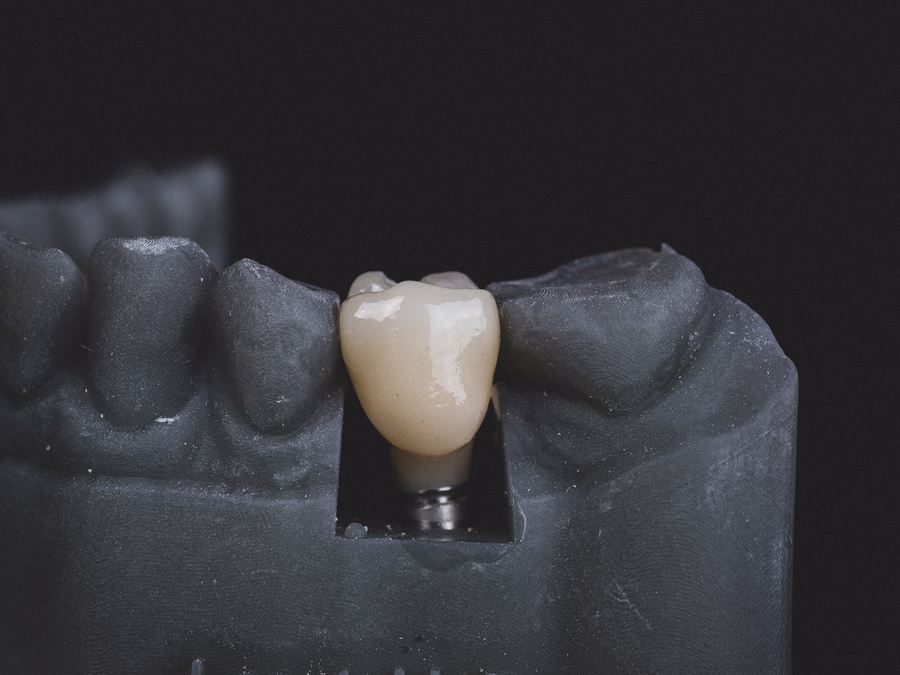 Milled implant crown seated on a titanium base in a printed model