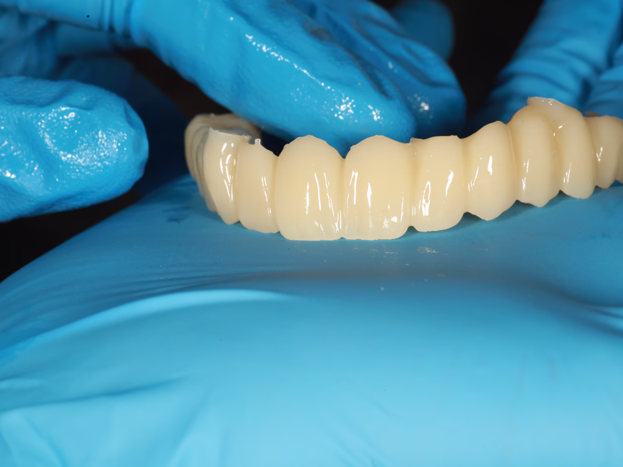 Finished screw-retained full-arch bridge held in gloved hands