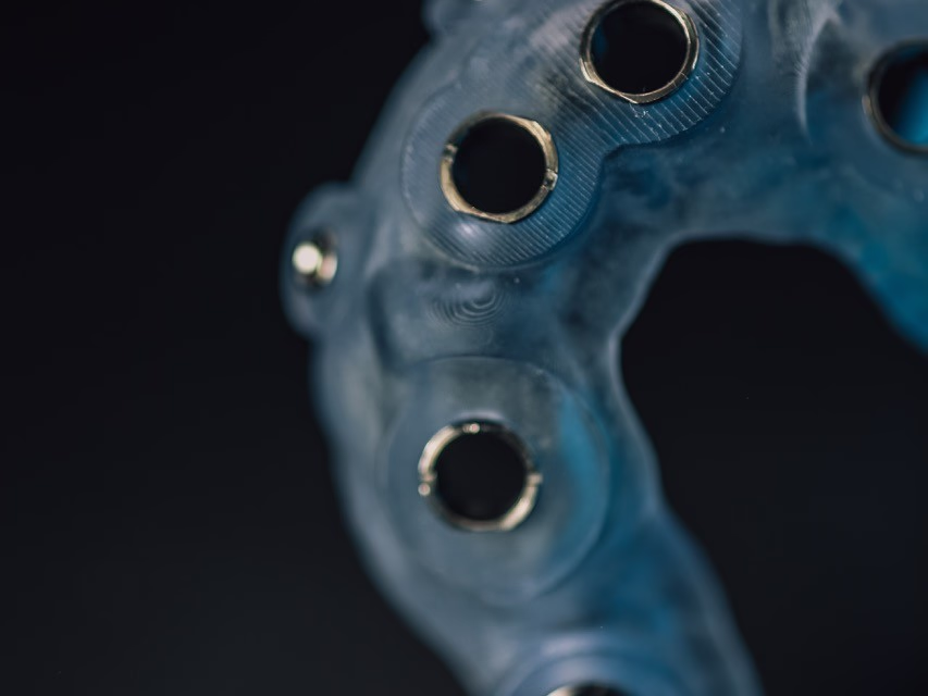 Printed single-implant surgical guide with metal drill sleeves