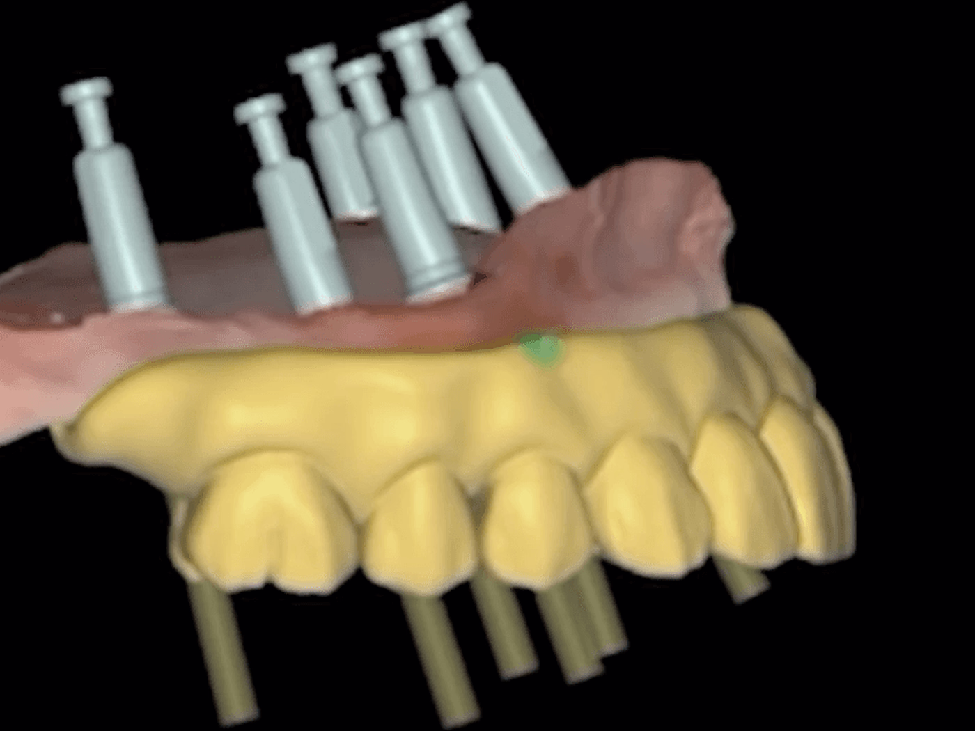 A full-arch plan on screen: the designed teeth over the planned implant and guide positions