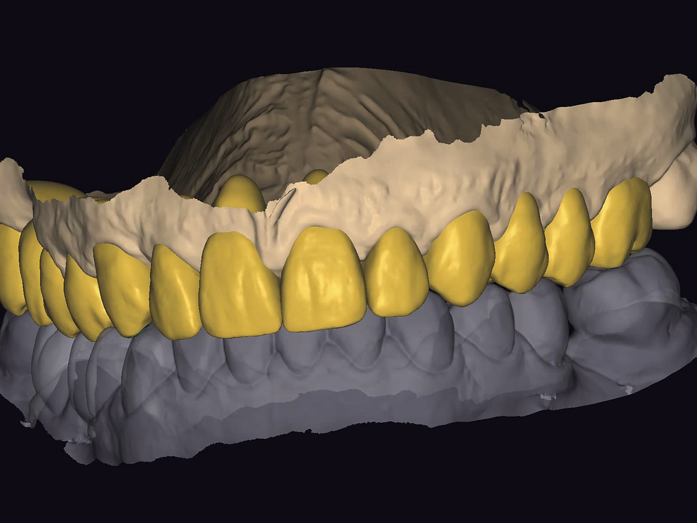 Full-arch design on screen: the planned teeth over the scanned arch