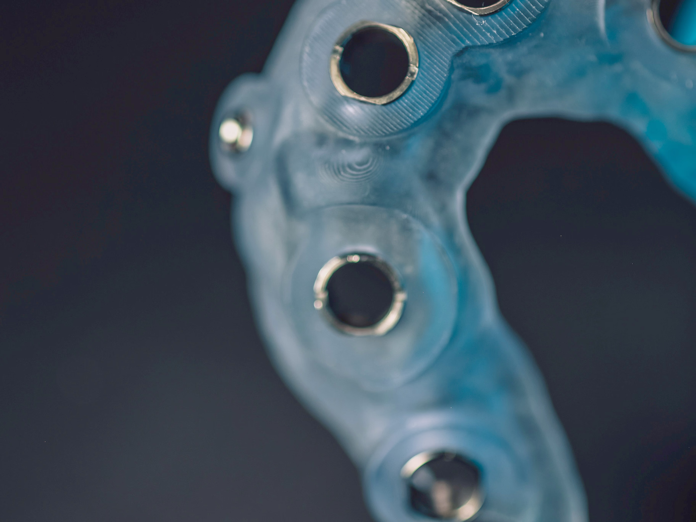 A printed full-arch surgical guide with metal drill sleeves
