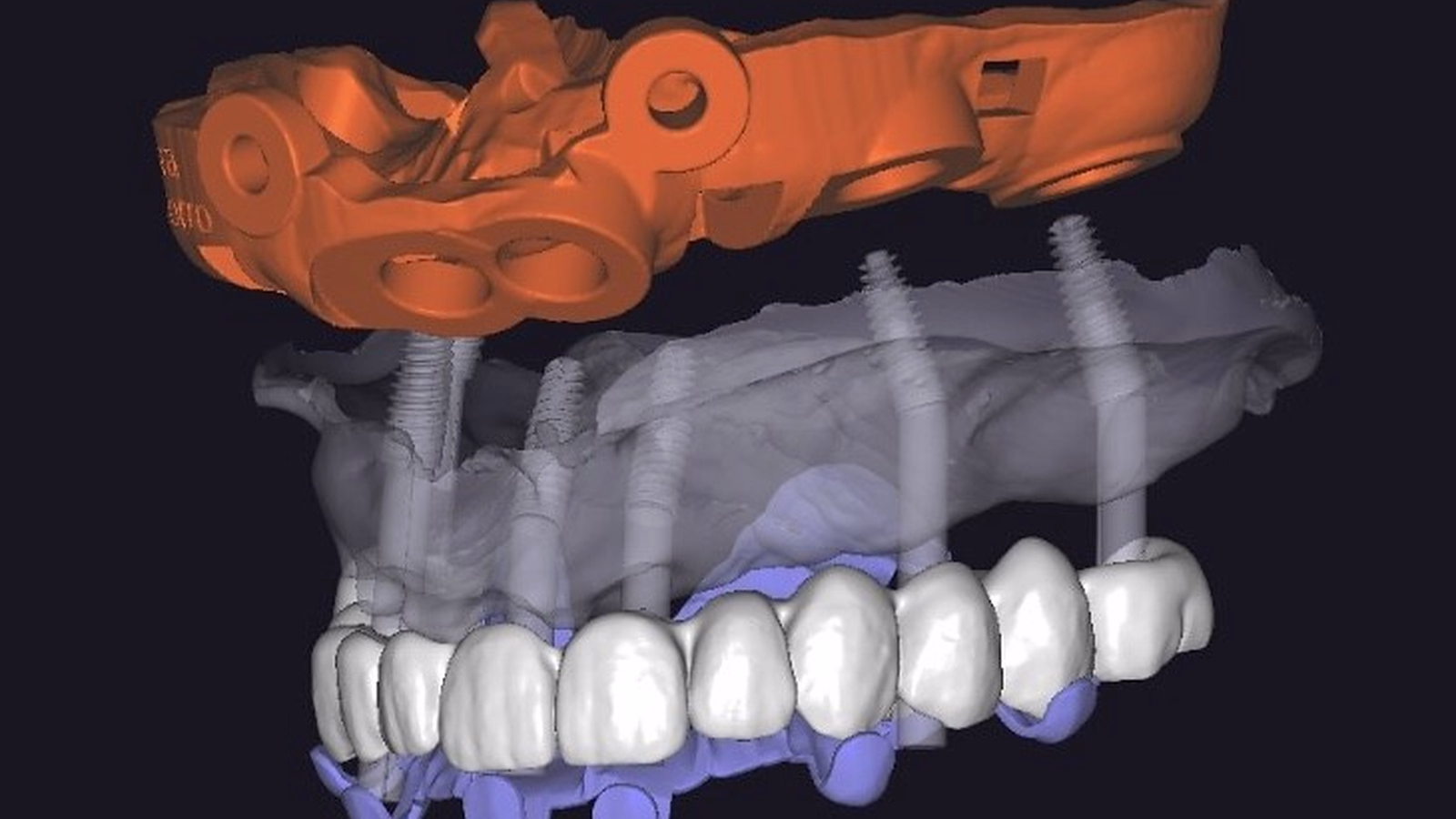 A full-arch bar design shown over the CBCT it was planned on