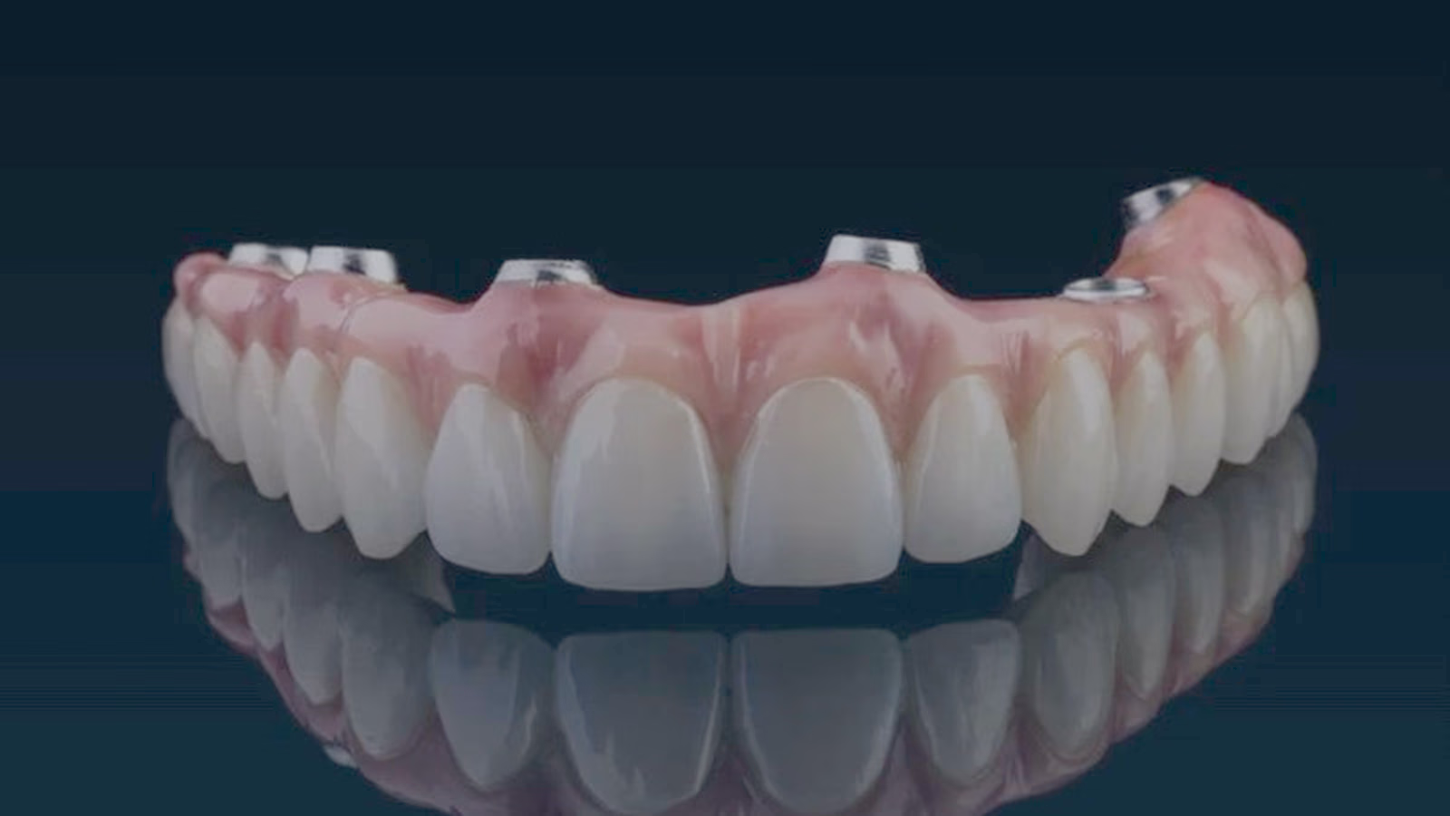 A finished screw-retained full-arch bridge with characterised gingiva and titanium bases