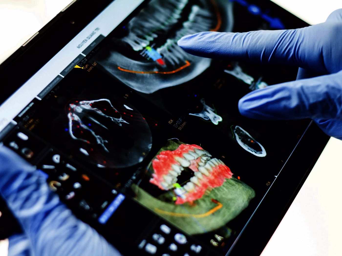A CBCT implant plan being reviewed on screen