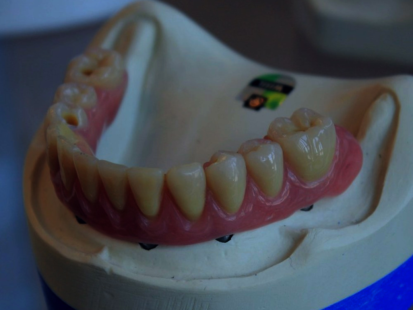 A full-arch acrylic provisional seated on the working cast over the implant analogs