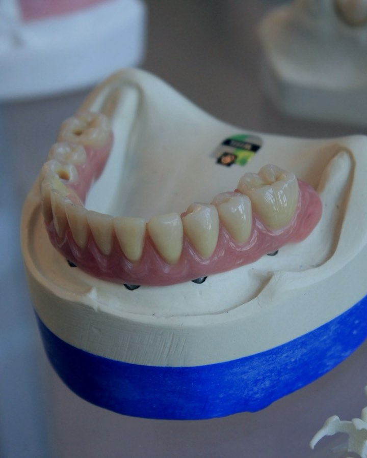 Full-arch provisional seated on the working model