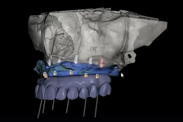 Implant positions and prosthetic setup planned in Blue Sky Plan